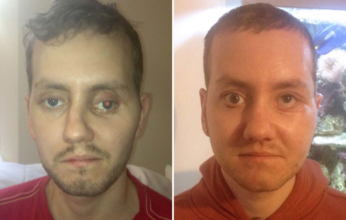 Before and after: after a motorbike crash, Stephen Power's skull was reconstructed with the help of 3D printing